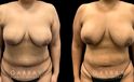 Patient 15 Front View Breast Fat Grafting Gabbay Plastic Surgery