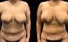 Patient 15 Front View Breast Fat Grafting Gabbay Plastic Surgery