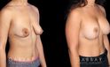 Procedures Depicted:  Breast Augmentation w/ Mastopexy – Silicone