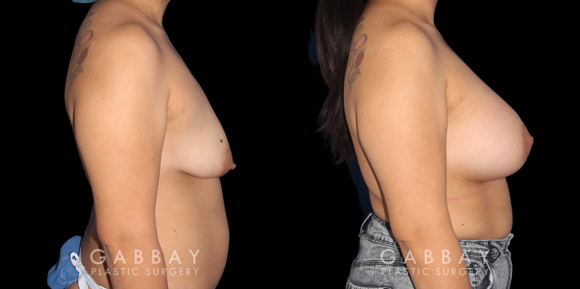 Procedures Depicted:  Breast Augmentation – Silicone & Lift
