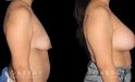 Procedures Depicted:  Breast Augmentation – Silicone & Lift