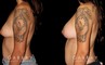 Before-and-after photos for patient with unilateral breast lift and bilateral breast augmentation. The improved symmetry restored a more natural look to the breasts with even nipple position.
