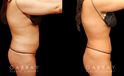 Female liposuction results with significant fat reduction in the abdomen for a tighter appearance while maintaining a natural-looking body contour. Patient recovered quickly and without complications.