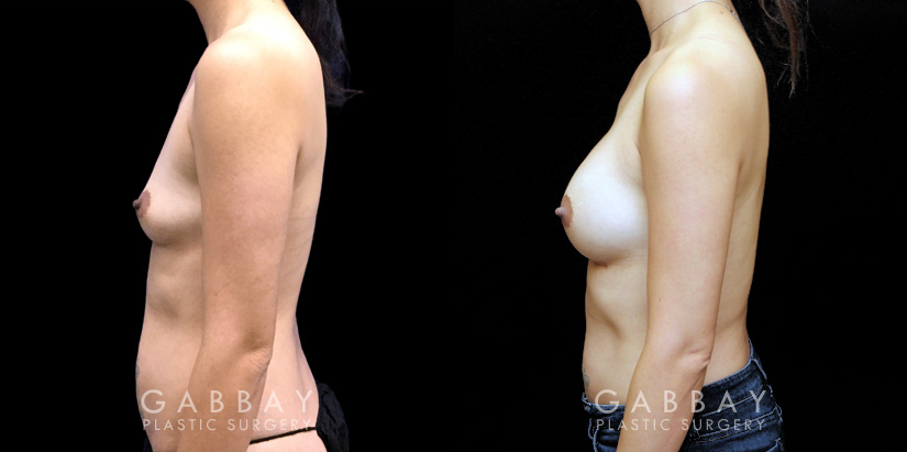 Procedures Depicted:  Breast Augmentation – Silicone