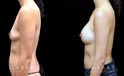 Procedures Depicted:  Breast Augmentation – Silicone