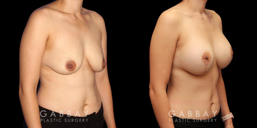 Procedures Depicted:  Scar Revision to Breasts