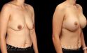 Procedures Depicted:  Scar Revision to Breasts