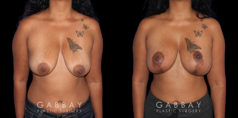 Procedures Depicted:  Wise Mastopexy with Silicone Breast Implants