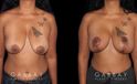 Procedures Depicted:  Wise Mastopexy with Silicone Breast Implants