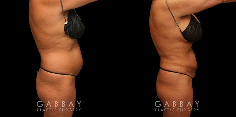 Procedures Depicted:  liposuction and j plasma to full abdomen Female African-American patient after liposuction and J plasma treatment to her full abdomen, reducing her bulging belly and to tighten and restore loose skin.