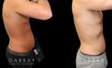Male liposuction results before and after the procedure, showing the tighter abdomen. Note the significant improvement shown when sitting, showcasing the reduced belly fat from lipo.