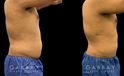 Male patient following 360 liposuction to the abdomen, sides, and back for a more youthful contour while maintaining a masculine feel to the body shape. The result is a tighter overall torso appearance.