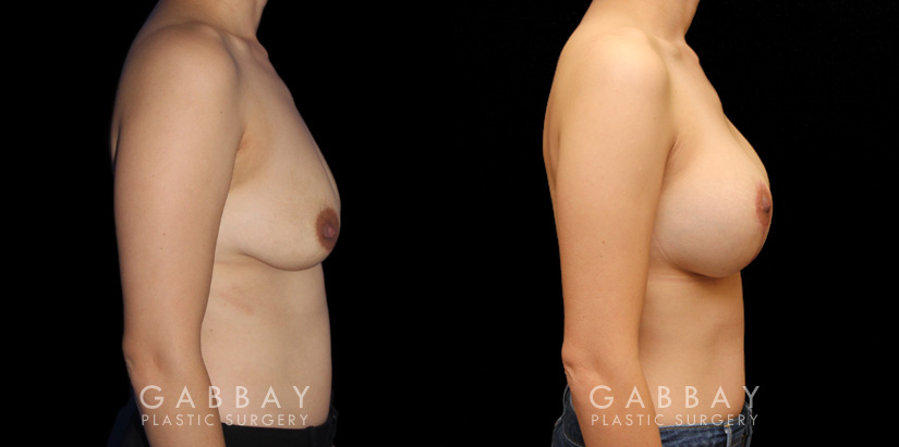 Procedures Depicted:  Augpexy