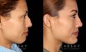 Patient 01 Right Side View Rhinoplasty Gabbay Plastic Surgery