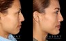 Patient 01 Right Side View Rhinoplasty Gabbay Plastic Surgery