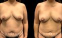 Patient 16 Front View Breast Fat Grafting Gabbay Plastic Surgery