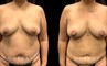 Patient 16 Front View Breast Fat Grafting Gabbay Plastic Surgery