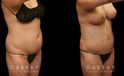 Patient before and after tummy tuck combined with breast augmentation and breast lift. By increasing breast volume, heightening breast position, and tightening the abdominal area, the patient has a slimmer, yet feminine figure.