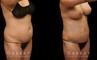 Patient before and after tummy tuck combined with breast augmentation and breast lift. By increasing breast volume, heightening breast position, and tightening the abdominal area, the patient has a slimmer, yet feminine figure.