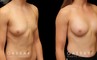 Patient wanted very mild breast augmentation to improve the roundness and curve of breasts. Results show increase from minimal breast shape to a gentle rounding slope to the breasts.