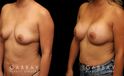 Before-and-after photos for female patient with breast augmentation. Classic results show improved size and volume of breasts with enhanced roundness from each angle.