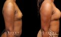 Patient before and after receiving silicone implants to increase breast roundness and overall volume. Results are shown following complete, smoother recovery.