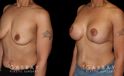 Patient with combined breast lift and breast augmentation using saline implants. Patient fully recovered from the combination procedure with excellent results.