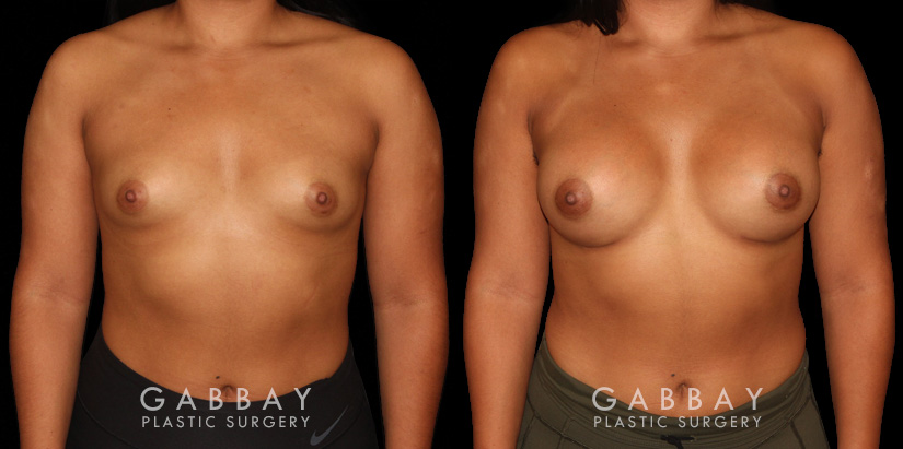 This is a young woman with a tuberous or constricted breast deformity. The lower portion of the breast developed more tightly than the rest of the breast. She wanted a more full, but natural breast appearance. She had silicone breast augmentation, with placement of an Allergan naturelle soft touch silicone breast implant through a lower breast/inframammary fold incision. Her moderate profile implants were 310 cc. Patients like this are prone to lower breast complications such as a double bubble, but with careful performance of the operation, she easily avoided this complication.