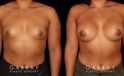 This is a young woman with a tuberous or constricted breast deformity. The lower portion of the breast developed more tightly than the rest of the breast. She wanted a more full, but natural breast appearance. She had silicone breast augmentation, with placement of an Allergan naturelle soft touch silicone breast implant through a lower breast/inframammary fold incision. Her moderate profile implants were 310 cc. Patients like this are prone to lower breast complications such as a double bubble, but with careful performance of the operation, she easily avoided this complication.