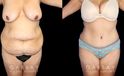 Patient results after liposuction to the back bra roll with significant abdominal tightening. Note the decrease in volume of abdominal fat and excess skin, with no visible scarring from any angle. Patient achieved a flat profile silhouette absent of any folds.