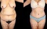 Patient results after liposuction to the back bra roll with significant abdominal tightening. Note the decrease in volume of abdominal fat and excess skin, with no visible scarring from any angle. Patient achieved a flat profile silhouette absent of any folds.