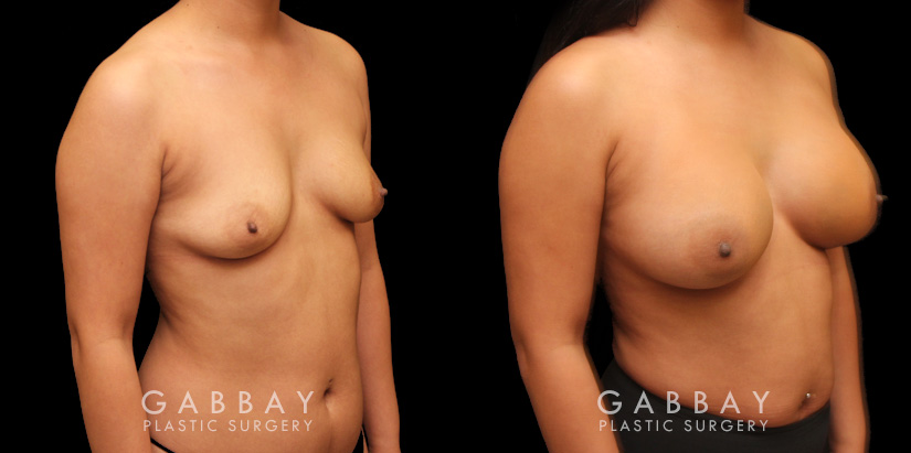 Photos for female patient before and after silicone implant procedure. Note the robust increase in breast size while continuing to match her body’s aesthetic for an aligned appearance.