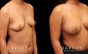 Photos for female patient before and after silicone implant procedure. Note the robust increase in breast size while continuing to match her body’s aesthetic for an aligned appearance.