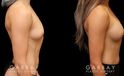 Patient wanted very mild breast augmentation to improve the roundness and curve of breasts. Results show increase from minimal breast shape to a gentle rounding slope to the breasts.