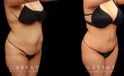 Patient photos from before and after tummy tuck. The full procedure combined abdominal tightening with liposuction, resulting in significant slimming of the front. Patient recovered smoothly with no complications.