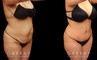 Patient photos from before and after tummy tuck. The full procedure combined abdominal tightening with liposuction, resulting in significant slimming of the front. Patient recovered smoothly with no complications.