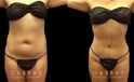 Female patient with enhanced abdominal contours after 360 liposuction surgery. Note the flattened stomach and the dynamic shape to her waist, restoring her natural curves.