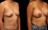 Before-and-after photos for female patient with breast augmentation. Classic results show improved size and volume of breasts with enhanced roundness from each angle.