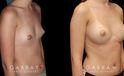 Before and after silicone breast implants for breast augmentation. Note the natural slope to the breasts and the symmetrical appearance while still increasing overall size.