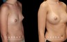 Before and after silicone breast implants for breast augmentation. Note the natural slope to the breasts and the symmetrical appearance while still increasing overall size.