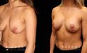 This patient had significant weight loss over time and wanted to have a more full and lifted breast look. She had Allergan Natrelle, soft touch, moderate profile implants placed (310 cc), and then underwent a breast lift to address the droop. She was happy with her soft, natural breast shape, and the dramatic change it made to her overall torso appearance.