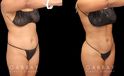 Full 360 view of patient following liposuction surgery focusing on removing belly fat, fat around the waist, and tailbone fat for a contoured result from every angle.