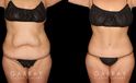 Note the significant tightening of the loose pockets of skin and stubborn fat around the abdomen following weight loss. After her tummy tuck, this patient saw a flattened stomach and enjoyed the benefits of her effort to lose weight.
