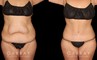 Note the significant tightening of the loose pockets of skin and stubborn fat around the abdomen following weight loss. After her tummy tuck, this patient saw a flattened stomach and enjoyed the benefits of her effort to lose weight.