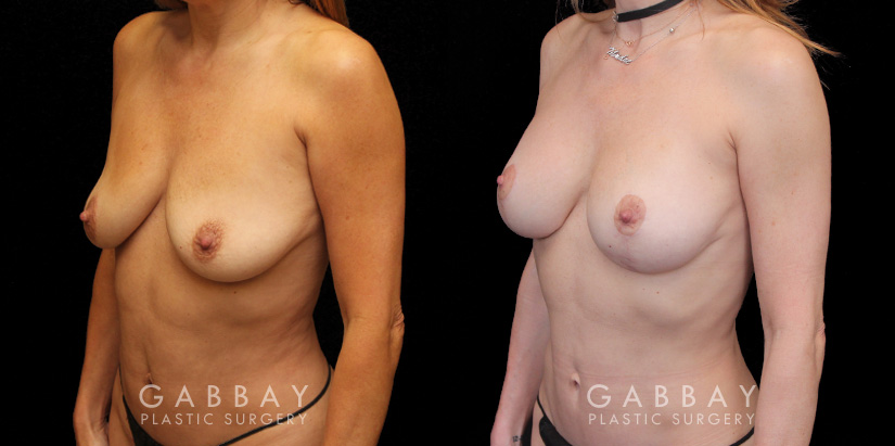 Procedures Depicted:  Implant Removal and lift