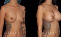 Silicone implant breast augmentation results for younger female patient. Multi-angle view allows for demonstration of the enhancement to her profile and overall silhouette contour.