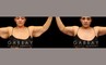 Patient 03 Front View Arm Lift with Lipo Gabbay Plastic Surgery