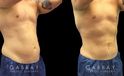 Male patient after abdominal liposuction, improving the patient’s torso shape and resulting in a more masculine contour from each angle with a flat abdomen. Compare to the sloping belly roundness before.