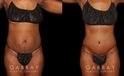 Patient following tummy tuck and hernia repair, showcasing results from multiple angles. Note the absence of stomach overhang in the leaning forward position, demonstrating effective tightening of multiple tissue layers.
