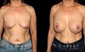 Procedures Depicted:  Breast Augmentation w/ Mastopexy – Silicone